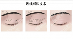 温州眼部整形医生大盘点，这些宝藏医生别错过！