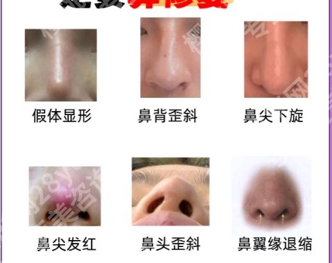 上海九院歪鼻手术费用贵不贵？全新价目表出炉！矫正美鼻指南~