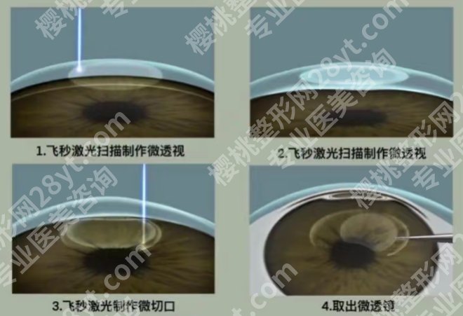 北京协和医院做飞秒手术当天能做完吗？一文查看医院详情内容！
