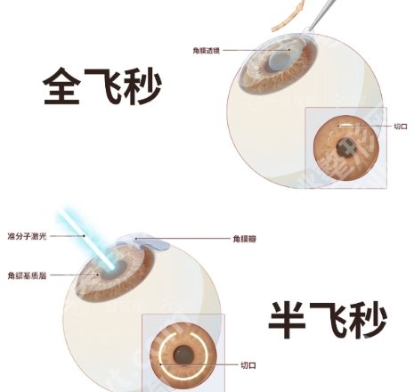 天津眼科医院做飞秒要提前多久预约？哪位医生技术不错？