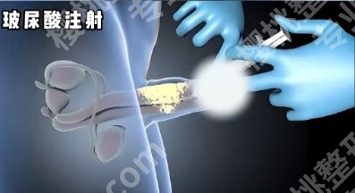 上海九院玻尿酸增粗费用价格明细表一览！医院设备及技术水平！