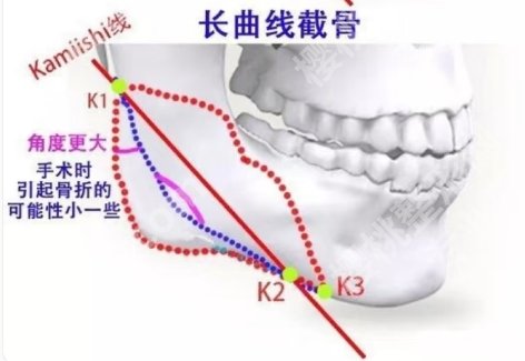 华西医院磨骨手术费用参考价格！医院技术雄厚|优势实力详情！