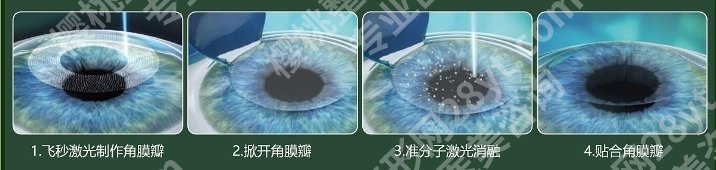 哈尔滨医大一有全飞秒激光吗？医院优势详情客户口碑超好！