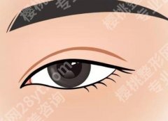 割双眼皮的后遗症和副作用是什么？这些隐患要当心