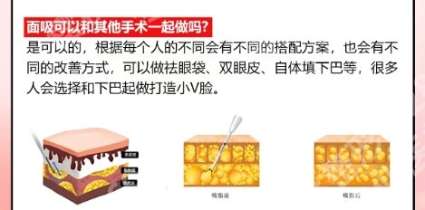 成都赵延峰面部吸脂技术实力强！医生擅长项目以及网友反馈！