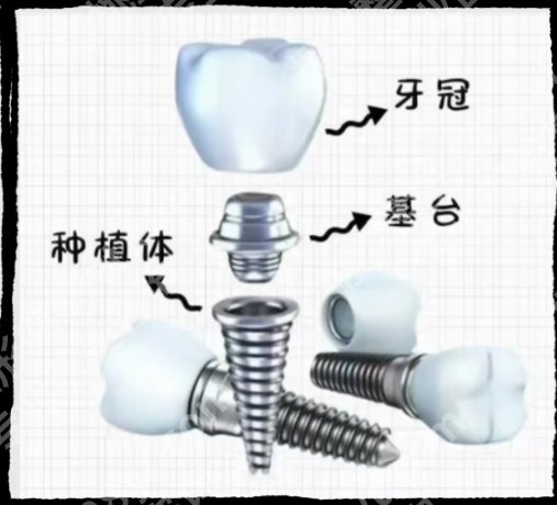 周口种牙镶牙哪个医院好？其中周口市中心医院|周口市中医院等都很不错！