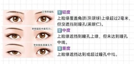 蚌埠割双眼皮哪里好？分享每一家医院的具体信息！点击查询