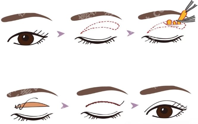 泉州割双眼皮医生排名已更新!一键了解医生排名上榜医生信息吧!!
