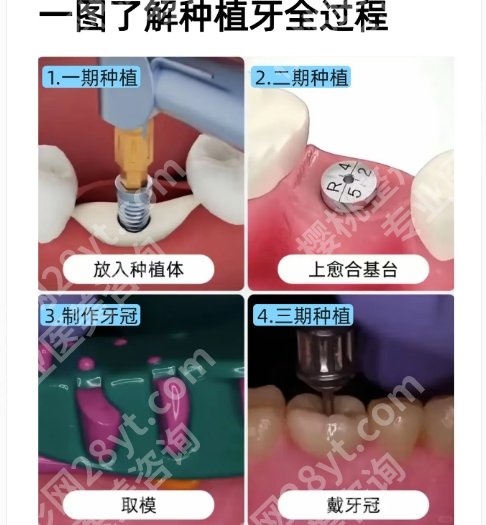 石家庄牙齿种植哪家好？石家庄市人民医院|石家庄雅芳亚医疗美容医院都很不错！