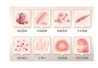 上海九院去疤痕挂什么科？医院实力不容小觑！