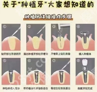 深圳牙齿种植医院排名更新啦！新鲜出炉的一手资料！一起来看看吧