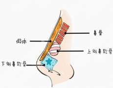 濡白天使隆鼻多少钱？整形真香但别真“伤”