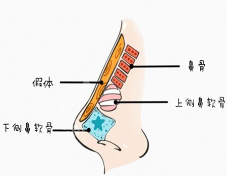 濡白天使隆鼻多少钱？整形真香但别真“伤”