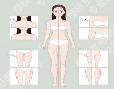 黄金微雕是吸脂吗？≠传统吸脂，原理大不同