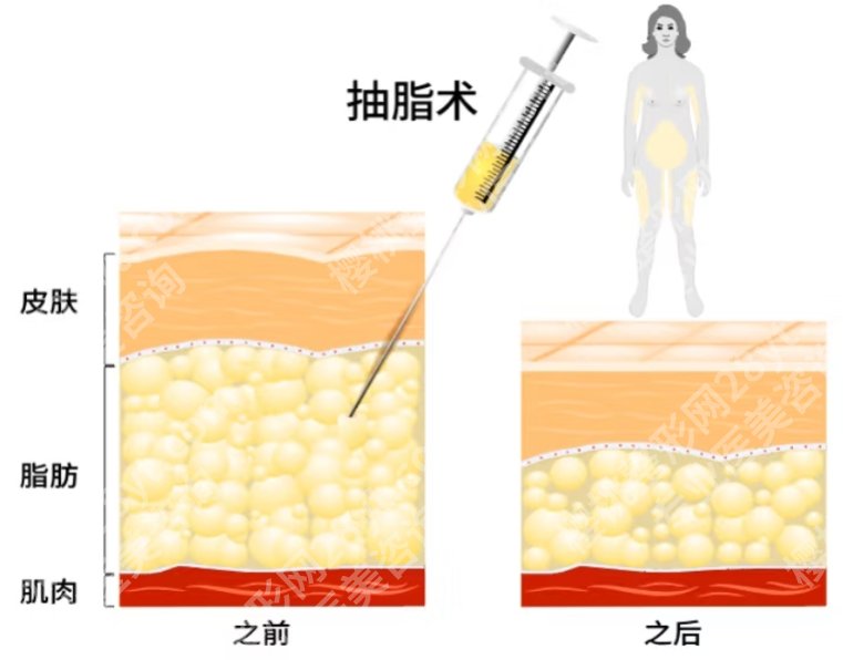 重庆军科医院抽脂手术做得好吗？医院实力水平优势！
