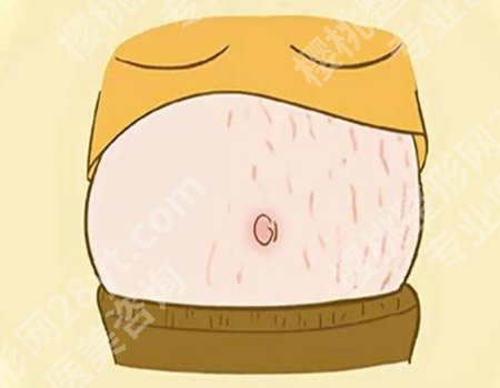 去妊娠纹激光多少钱？费用背后的惊人真相速看