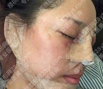 软骨隆鼻后遗症有哪些症状？鼻子挺了，人生塌了？到底值吗？