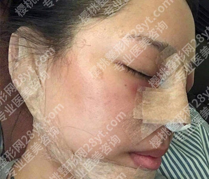 软骨隆鼻后遗症有哪些症状？鼻子挺了，人生塌了？到底值吗？