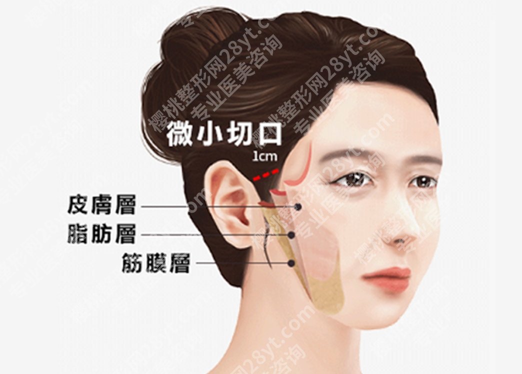 筋膜提升能维持多久？花了大价钱，效果能挺几个月？还是几年？
