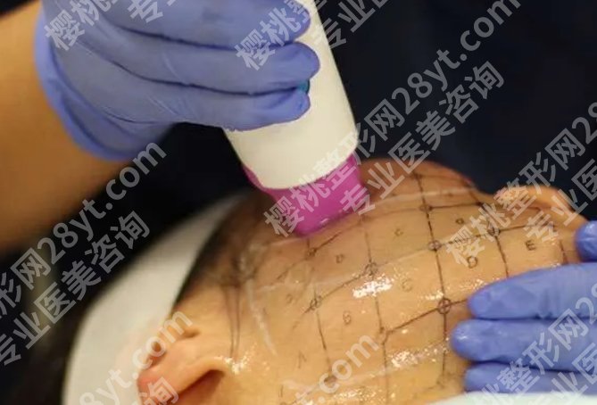 热玛吉一年后会更松吗？实测经验+医生说法都在这
