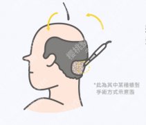 青岛植发医院排名，真人案例+实操体验，避坑不求人