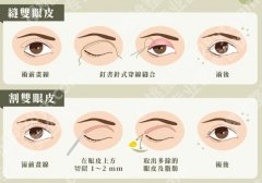 双眼皮一个月和三个月，恢复进度条全解析，新手别被前期状态吓退