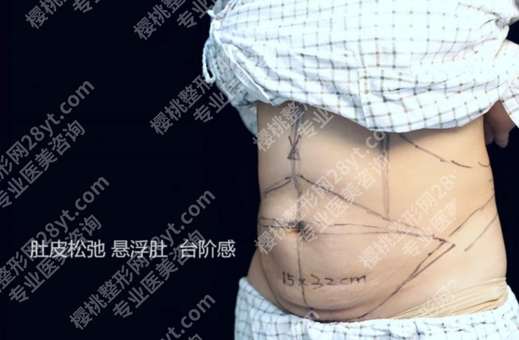 徐礼亮医生腹壁成形如何？想要“产后”？靠运动真不一定够