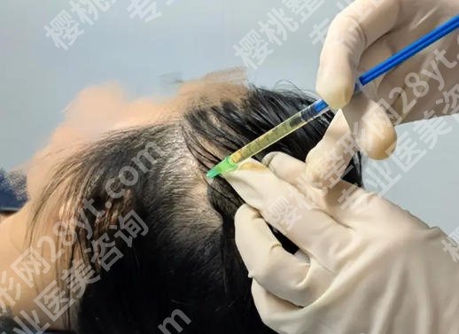 cgf脱发注射几次见效？准确答案来了