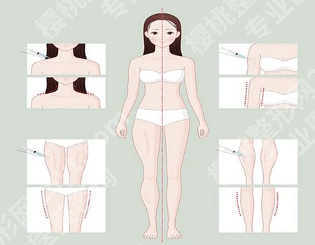 吸脂一个部位多少钱？影响因素+不同部位报价，费用透明化