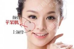 丁昆琨苹果肌复位怎么样？技术细节、效果维持、恢复期——一次说清楚