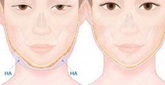馒化脸怎么修复？不是胖，是轮廓糊了：如何找回立体感
