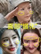 馒化脸做热玛吉还是超声炮？别再盲目跟风，馒化脸修复有科学路径