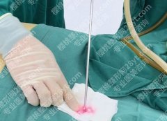 5g天使光雕吸脂恢复期，护理得当=事半功倍，偷懒大意=前功尽弃