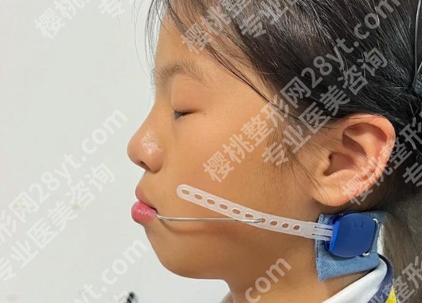 下颌骨矫正手术价格大概需要多少钱?关于价格，那些你想知道的都在这