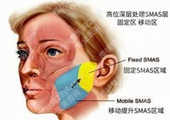 smas除皱术危险吗？效果能维持10年？先搞清楚这6大风险再决定！