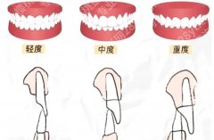 矫正深覆合要多少钱？牙套一上，颜值上线，价格也有点在线…