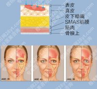筋膜提升几年后会更老吗？几年后脸会不会崩？医生说话了！