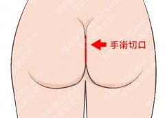 丰臀有几种方案？丰臀是门学问，不同方案适合不同‘座驾’！