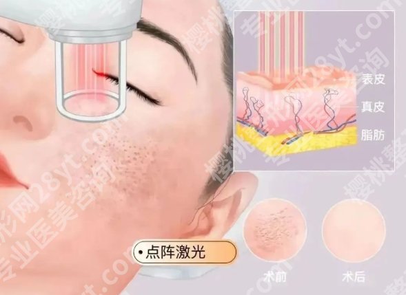 点阵激光对凹陷疤痕有用吗？皮肤科的隐藏buff：疤痕真有戏