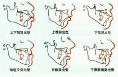 牙性嘴凸矫正需要拔牙吗？真相来了｜拔牙≠可怕，矫正≠必拔