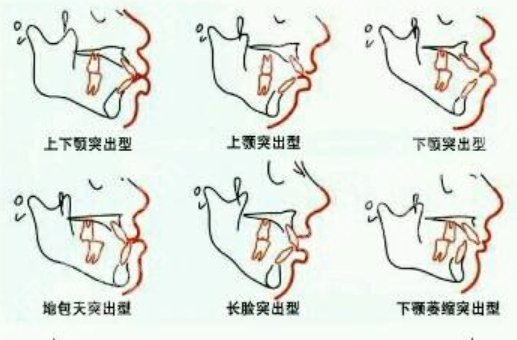牙性嘴凸矫正需要拔牙吗？真相来了｜拔牙≠可怕，矫正≠必拔