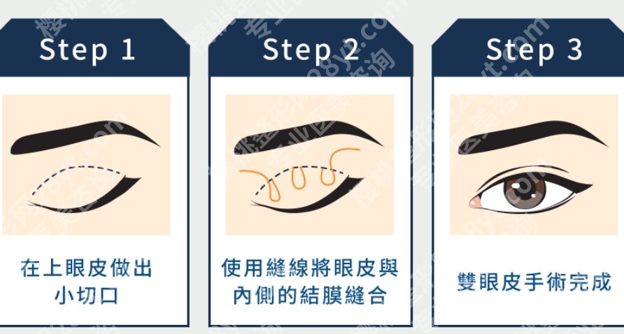微创双眼皮手术费用多少钱？想花小钱变大眼？微创双眼皮的收费你必须提前摸清楚！