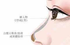 周顺波鼻子案例，鼻子的小改动大不同，给爱美的人又多了一份参考