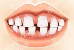 牙齿不齐是什么原因导致的？各种情况一一分析