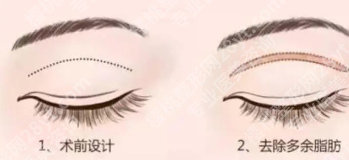 广州中山大学附属第一医院割双眼皮怎么样？真人做眼部整形全流程分享