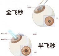 北大深圳医院近视眼手术怎么收费？新版价格表公布！