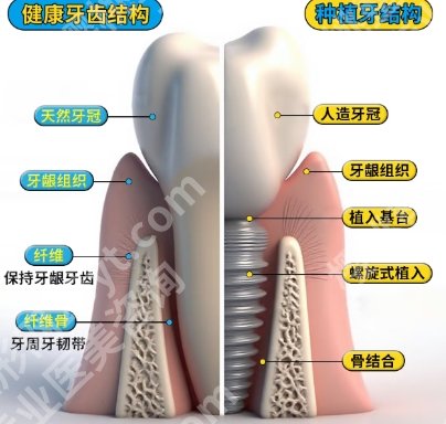 潞河医院种牙价格贵不贵？2025项目收费标准参考！