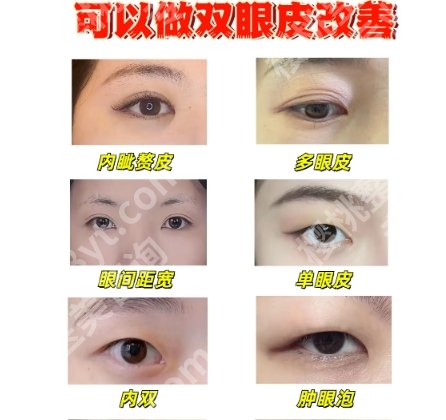 哈医大一院双眼皮怎么样?网友经典案例图展示!