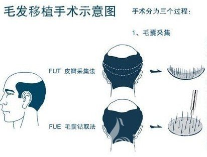 济南植发比较好的医生速查，邱晓东等5位专家资料深扒，含价格