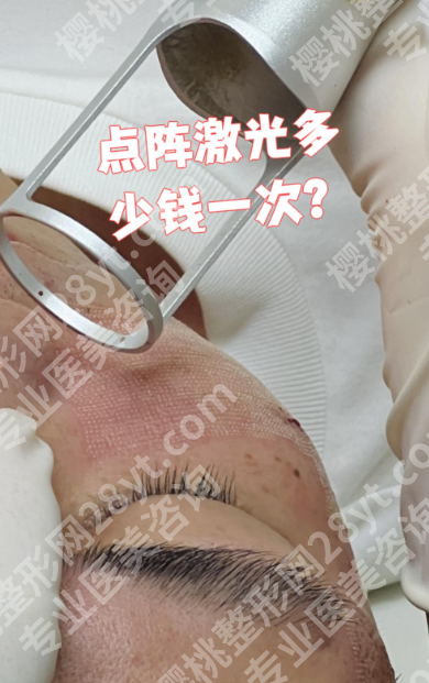 成都第二人民医院点阵激光多少钱？2025年新价格表+真人案例全解析！
